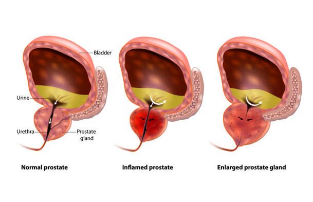 prostatitis adalah peradangan pada kelenjar prostat