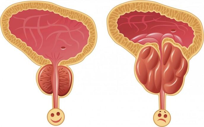 prostat yang sehat dan meradang dengan prostatitis