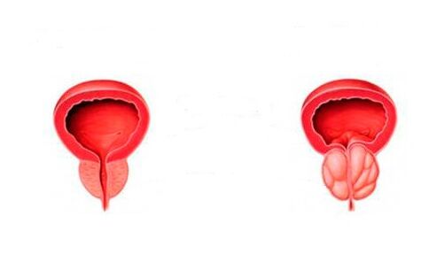 prostat yang sehat dan meradang dengan prostatitis