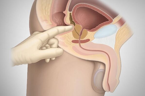 Pijat prostat untuk prostatitis bakteri