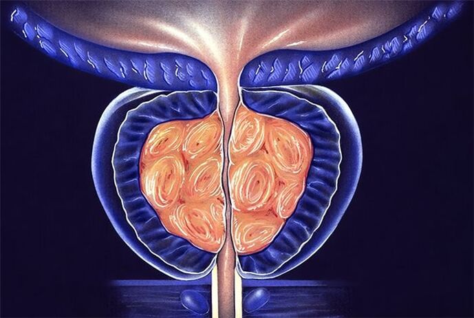 gejala dan pengobatan prostatitis