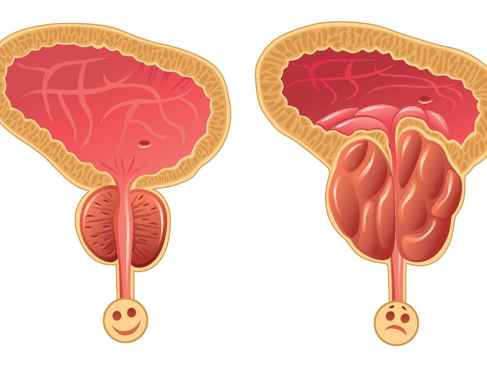 Kelenjar prostat yang sehat dan kemacetan prostat dengan prostatitis kongestif