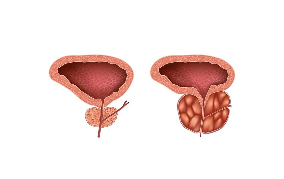 gejala prostatitis pada pria