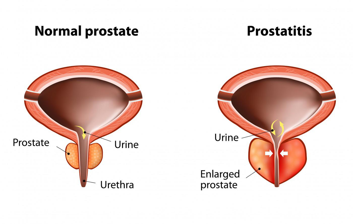 Prostat normal pria sehat dan radang kelenjar prostat dengan prostatitis