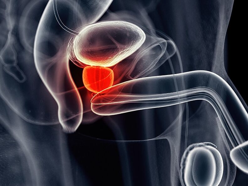 Peradangan kelenjar prostat menyertai prostatitis kronis