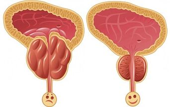 bagaimana prostatitis ProstEro bekerja sebelum dan sesudah pengobatan